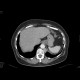 Vena cava sinistra, continuation of hemiazygous vein: CT - Computed tomography
